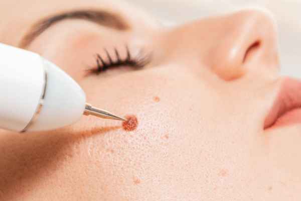 CryoPen: 5 Skin Concerns It May Be Used to Treat 3 What actually happens during a CryoPen treatment Barry?