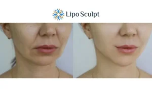 Explaining Total Skin Tightening Treatment And What It Can Do For You 2 Do you want to boost your self confidence? Give Morpheus8 Barry a try today!