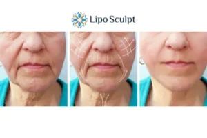 Explaining Total Skin Tightening Treatment And What It Can Do For You 3 Boost your confidence with Morpheus8 Barry call our team today!