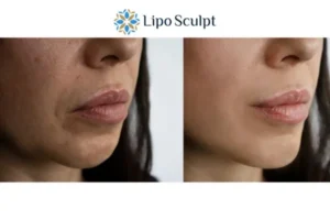 Explaining Total Skin Tightening Treatment And What It Can Do For You 4 Morpheus8 Barry the best results - call our team today!