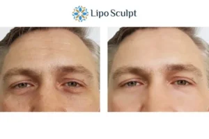Explaining Total Skin Tightening Treatment And What It Can Do For You 6 Morpheus8 Barry book in today to find out more!