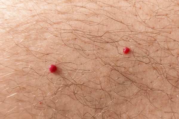 CryoPen: 5 Skin Concerns It May Be Used to Treat 2 cherry angioma removal Barry