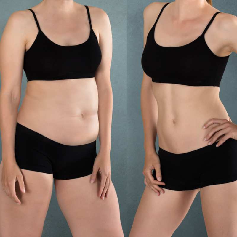 Does Fat Freezing at Home Work? DIY Devices vs Professional Cryolipolysis 2 before and after Cryolipolysis Barry