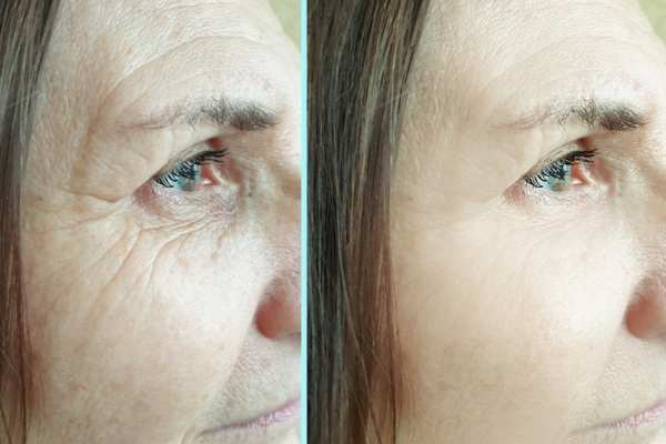 Why Do People Choose HIFU for a Non-Surgical Facelift? 4 How long can HIFU results last Barry?