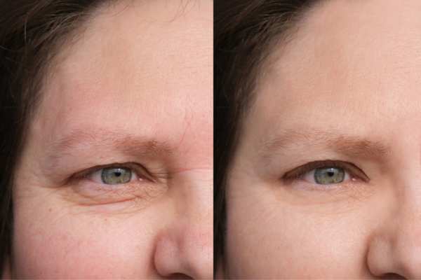 HIFU vs Botulinum Toxin: Understanding the Differences 4 How long do HIFU results last Barry?